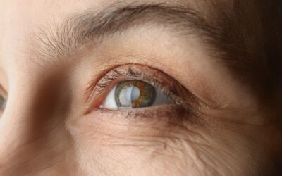 Cataract Prevention: Tips for Maintaining Healthy Eyes