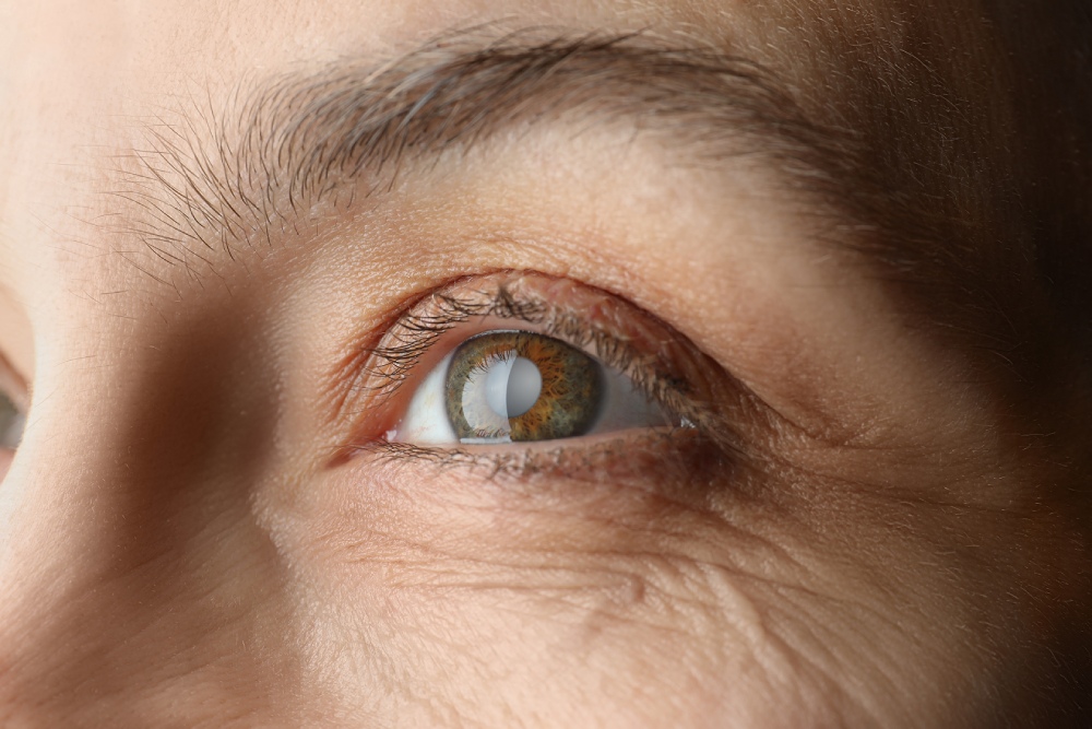 Cataract Prevention: Tips for Maintaining Healthy Eyes