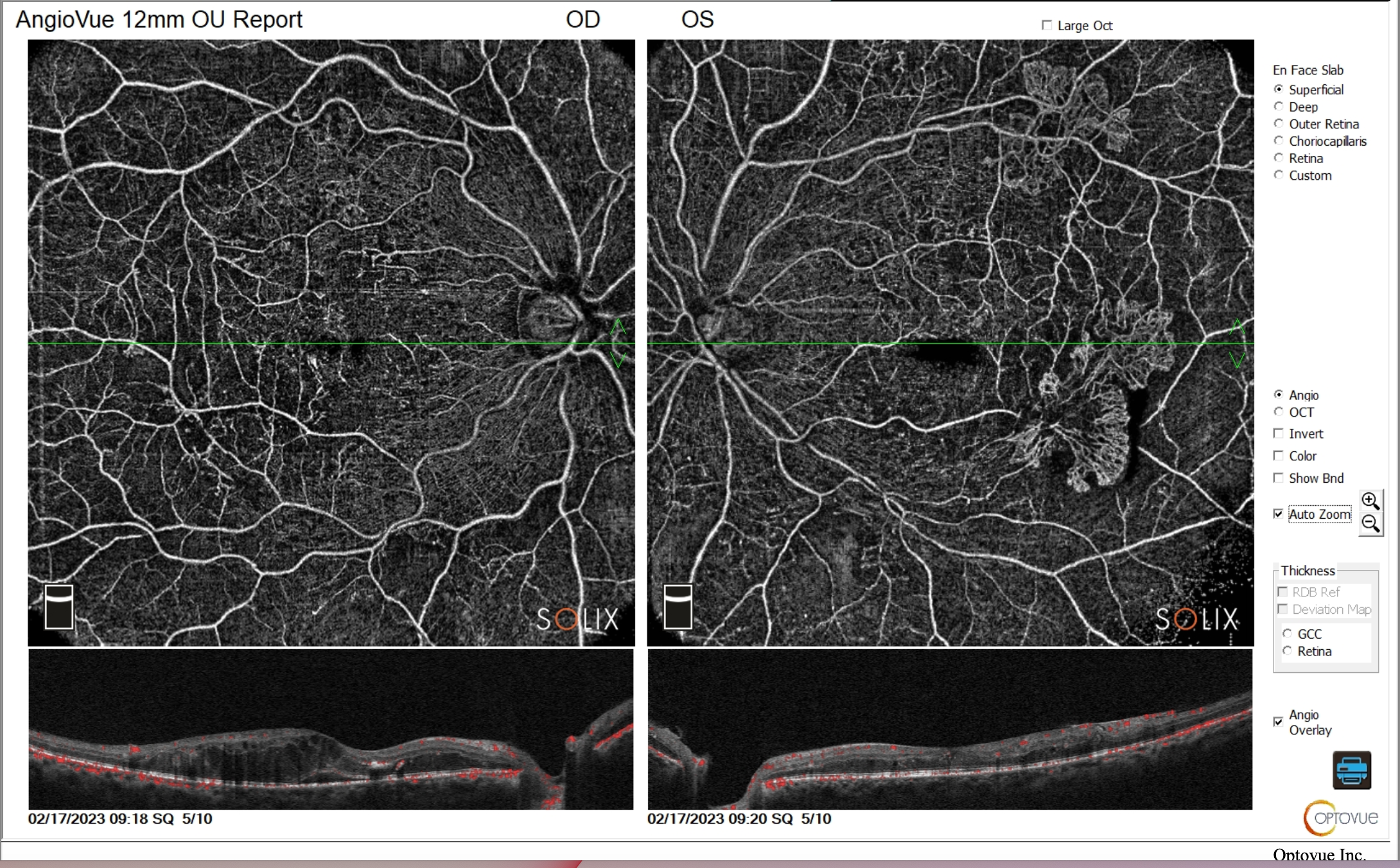 PosteriorRodmanPDR2 Side-by-side OCT angiography scans show the right (OD) and left (OS) retinas, highlighting blood vessels and cross-sectional retinal layers with labeled parameters.